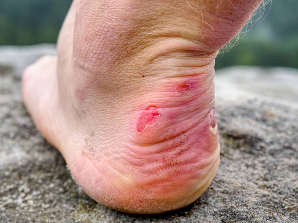 Trailläufer ruhen sich in den Bergen aus. Beine mit blutigen Blasen in felsigem Gelände, Sportschuhlose Beine Detail - Foto, Bild
