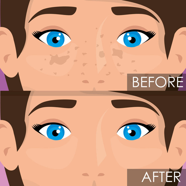donna prima e dopo il trattamento della pelle
 - Vettoriali, immagini