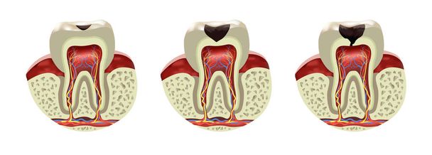 İnsan diş çürüğü hastalığı çapraz kesim bölümü gerçekçi, vektör çizim - Vektör, Görsel