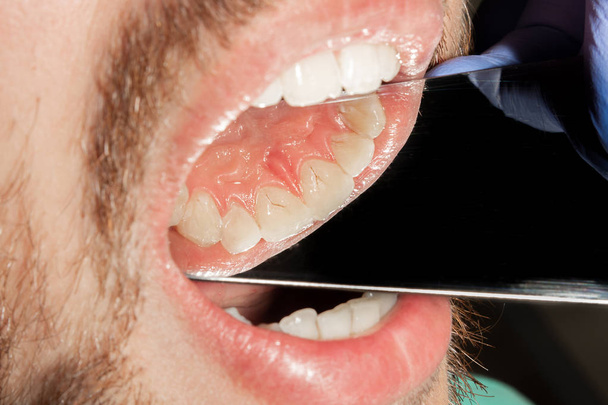 Zahnstein Nahaufnahme an den unteren vorderen Schneidezähnen. Zahnhygiene der Zähne - Foto, Bild