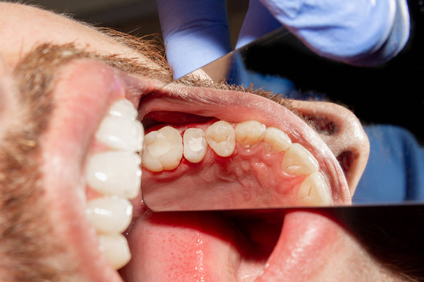 крупним планом людський гнилий каріозний зуб на стадії лікування в стоматологічній клініці. Використання гумової греблі з латексними шарфами та металевими затискачами, виробництво фотополімерних композитних пломб
 - Фото, зображення