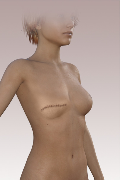 Mujer sin seno después de una mastectomía. Cicatriz en el cuerpo. Mastectomía es el término médico para la extirpación quirúrgica de uno o ambos senos, parcial o completamente. renderizado 3d
 - Foto, Imagen