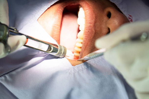 Anästhesie zur Zahnextraktion durch den Zahnarzt. Zahnmedizin im Krankenhaus. - Foto, Bild