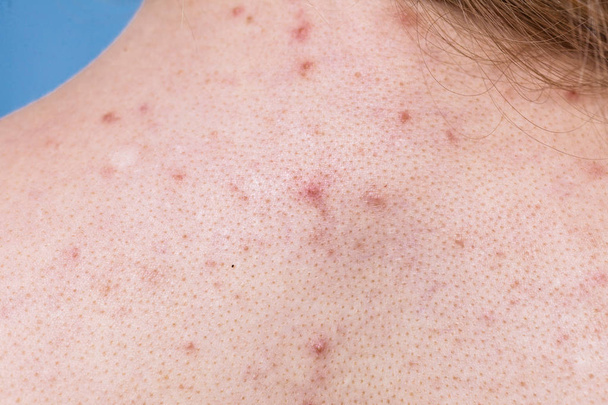 Health problem, skin diseases. Human back with acne, red spots, pimples. - 写真・画像