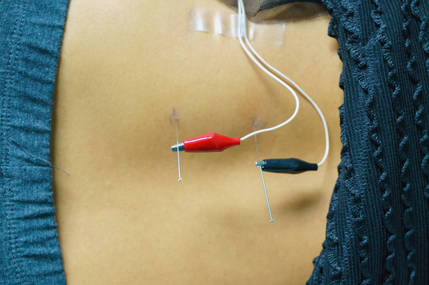 doctor sticks needles into the girl's back on acupuncture with Electrical stimulator. - Photo, Image