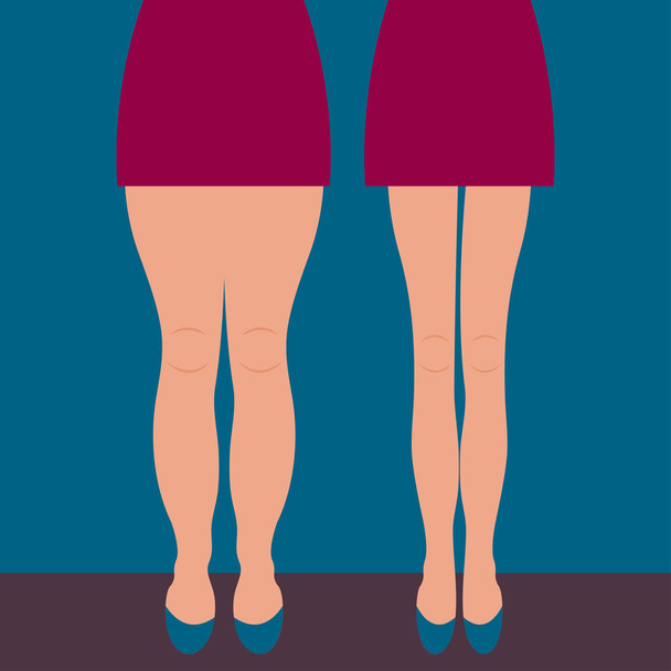 Piernas gruesas y delgadas femeninas antes y después de la pérdida de peso, hermoso cuerpo, piernas de liposucción, masaje de piernas. Ilustración vectorial
 - Vector, imagen