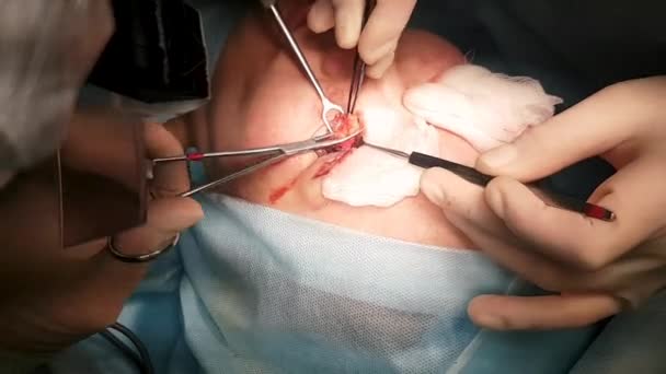 Il chirurgo sta eseguendo un'operazione agli occhi, primo piano. Correzione di. Il dottore fa la blefaroplastica. Operazione in sala operatoria
. - Filmati, video