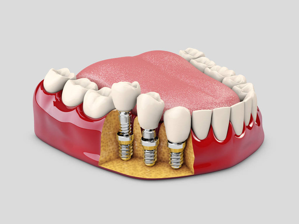 Human teeth and Dental implant. 3d illustration. - Photo, Image