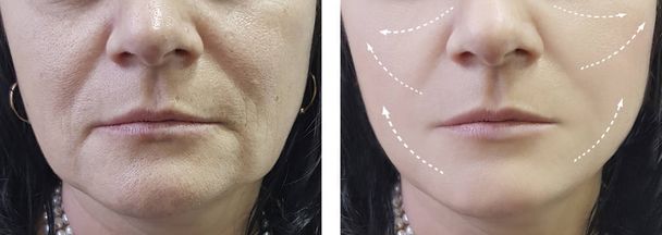 arrugas de la mujer antes y después de procedimientos
 - Foto, Imagen