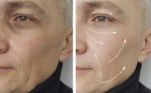 чоловічі зморшки до і після процедур
 - Фото, зображення