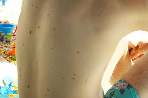 back of a man covered with lots of moles - Photo, Image