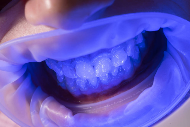 Dentes de branqueamento UV. Administrar anestésicos para evitar que os pacientes sintam dor durante os procedimentos. Lâmpada ultravioleta de enchimento de dentes. Comparação após clareamento dos dentes
. - Foto, Imagem