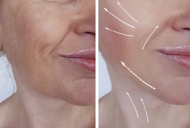 rugas mulher rosto antes e depois de procedimentos
 - Foto, Imagem