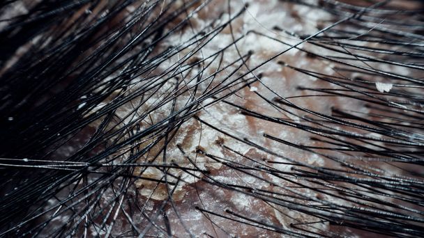 Macro de cuero cabelludo asiático humano con cabello negro tienen un problema con la caspa y escamosa de la psoriasis porque hormonal, sucia y el estrés
 - Foto, Imagen
