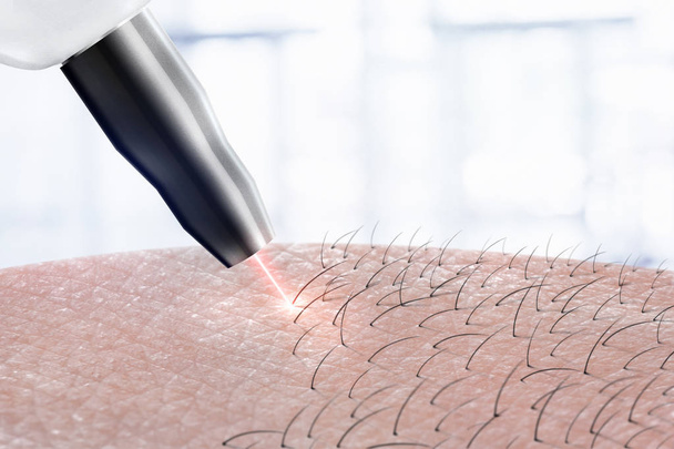 Kosmetologie Verfahren Laser-Haarentfernung an Körperteilen. Laserepilation. - Foto, Bild