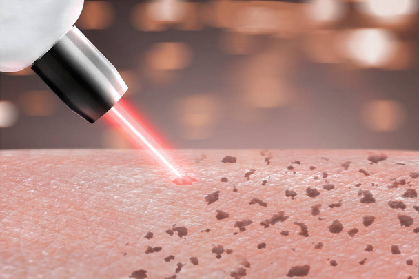 κοσμετολογία διαδικασία λέιζερ freckle αφαίρεσης δέρματος σε μέρη του σώματος. κοντινό πλάνο - Φωτογραφία, εικόνα