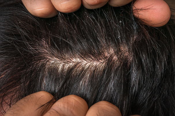 Крупный план волос человека с перхоти - концепция псориаза
 - Фото, изображение