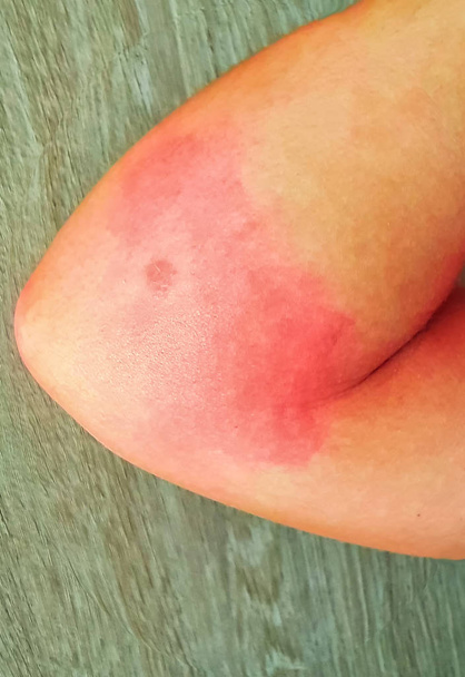 Vörös bőrkiütés a betegnél, akit megharapott egy rovar - Fotó, kép