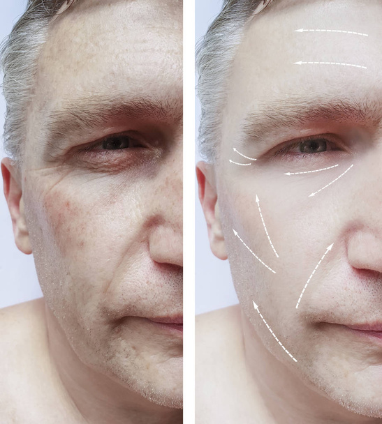 male face wrinkles before and after procedures - Photo, Image