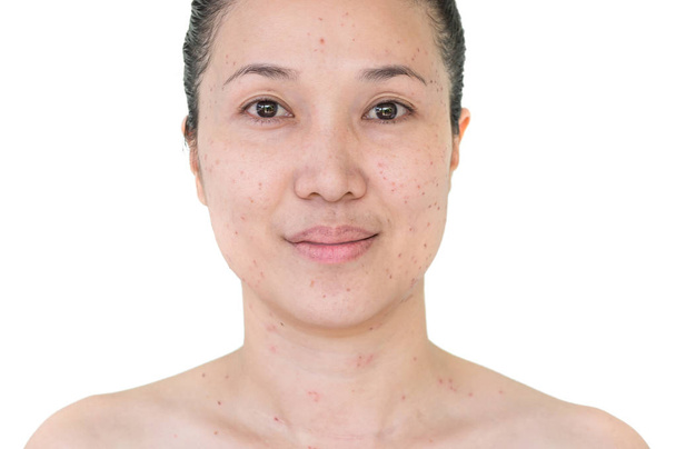Branden van vlekken of korsten van laser behandeling acne huid, sproeten, sproeten en donkere vlekken op het gezicht en de hals van Aziatische vrouw. - Foto, afbeelding