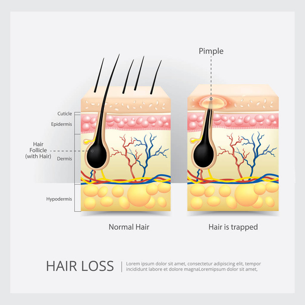 Ingrown Hair Structure Vector Illustration - Vector, Image