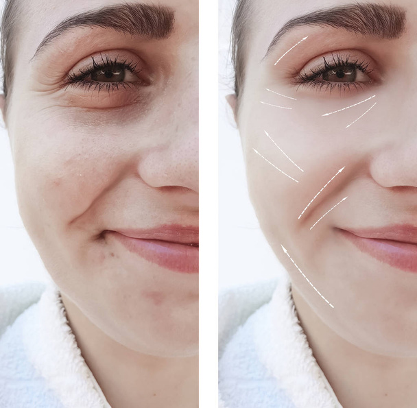 cara hermosa chica arrugas en la cara antes y después de los procedimientos
 - Foto, imagen