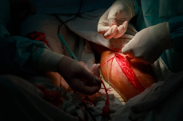 Medici in sala operatoria durante la procedura di chirurgia venosa. Medici che eseguono la procedura di chirurgia venosa
 - Foto, immagini