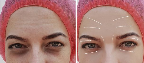 αντιμετωπίσει τις ρυτίδες στο πρόσωπο όμορφο κορίτσι πριν και μετά από διαδικασίες, βέλος - Φωτογραφία, εικόνα