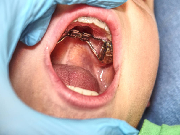 口歯リテーナ ブレースを有する。矯正歯科のテーマ歯 (一口) 補正法ハイラックスと保税拡張機器 - 写真・画像