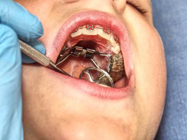 Zubní rovnátka v ústech mladík. Dospívající s rovnátka na zuby. Makro snímek zubů s kšandami. Ortodontická léčba.  - Fotografie, Obrázek