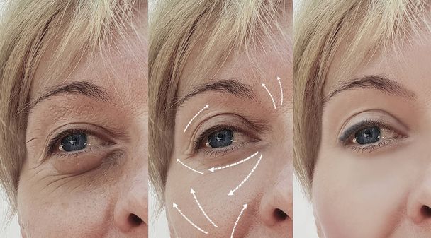 жіночі зморшки для обличчя до і після косметичних процедур, стрілка
 - Фото, зображення
