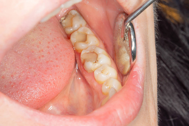 Οδοντιατρική τερηδόνα. Γέμισμα με σύνθετο οδοντιατρικό υλικό φωτοπολυμερούς με τη χρήση ραβδιστών. Η έννοια της οδοντιατρικής θεραπείας σε οδοντιατρική κλινική - Φωτογραφία, εικόνα