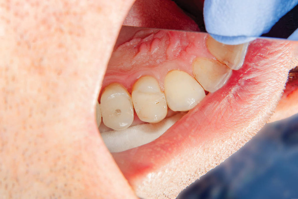 twee kauwen kant tanden van de bovenkaak na behandeling van cariës. Restauratie van het kauwen oppervlak met een fotopolymeer materiaal via het systeem van Rubber Dam vullen - Foto, afbeelding