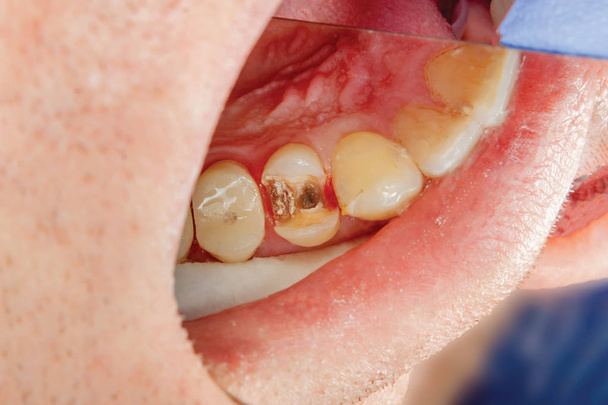 dos dientes laterales masticables de la mandíbula superior después del tratamiento de la caries. Restauración de la superficie de masticación con un material de llenado de fotopolímero utilizando el sistema de presa de goma
 - Foto, Imagen