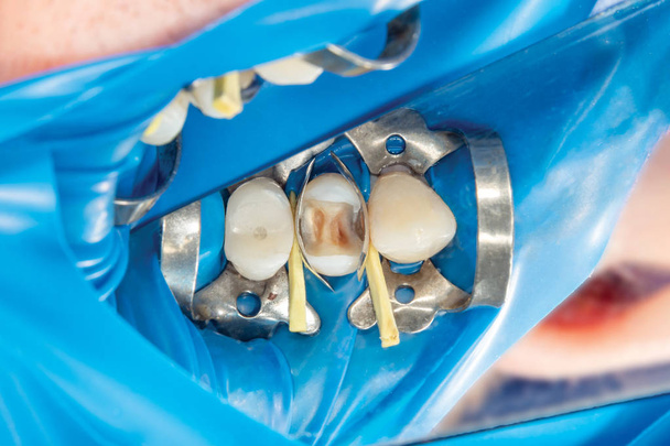 deux dents latérales à mâcher de la mâchoire supérieure après traitement des caries. Restauration de la surface à mâcher avec un matériau de remplissage photopolymère à l'aide du système de barrage en caoutchouc
 - Photo, image