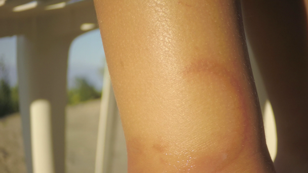 la blessure causée par la morsure d'une méduse Pelagia noctiluca sur la jambe de l'enfant
 - Séquence, vidéo