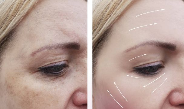 морщины лица женщины до и после процедур, стрела
 - Фото, изображение