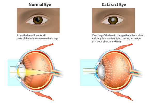 ataract es una opacidad de la lente. Ilustración médica de un ojo normal y un ojo con una catarata, lente nublada
 - Vector, Imagen