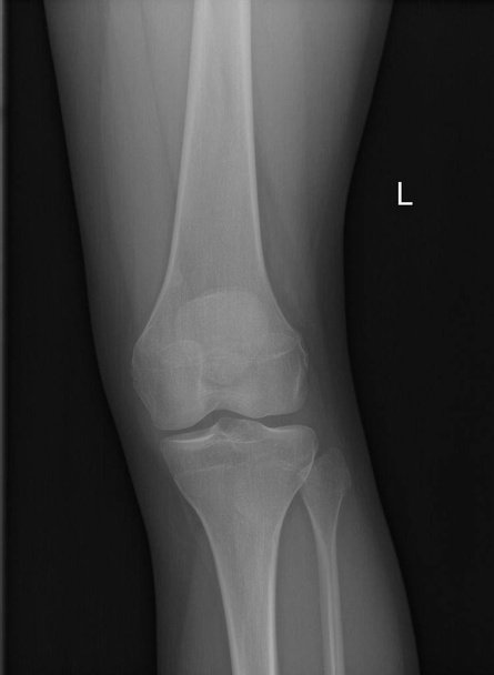 insan diz ballottement ve genel hyperlassity yerinden çıkması sonucu olarak genç kadın hastada gösteren röntgen grafisi - Fotoğraf, Görsel