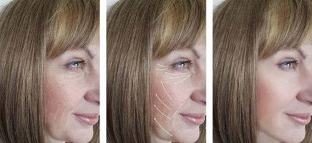 woman facial wrinkles correction before and after procedures arrow - Photo, Image