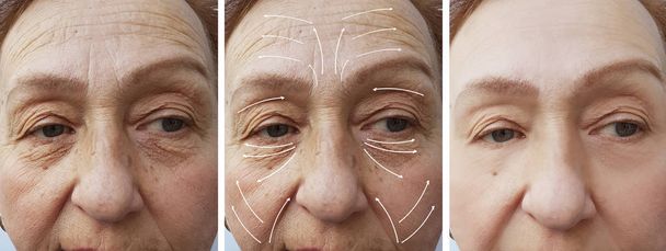 ηλικιωμένοι γυναίκα του προσώπου ρυτίδες διόρθωση πριν και μετά από διαδικασίες βέλος - Φωτογραφία, εικόνα