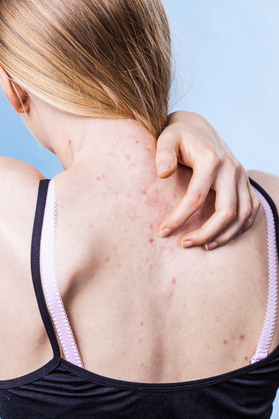 Health problem, skin diseases. Young woman showing her back with acne, red spots. Teen girl scratching her shoulder with pimples. - Фото, изображение