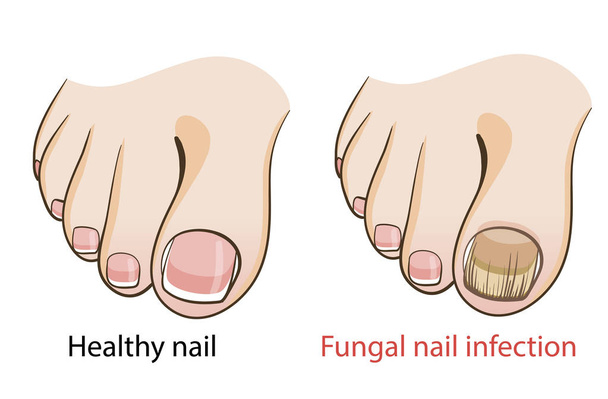 Nail fungal infection Medical poster - Vector, Image