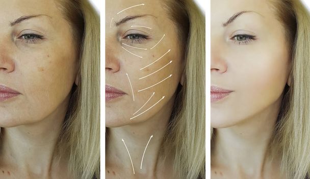 face woman wrinkles correction before and after procedures, arrow - Photo, Image