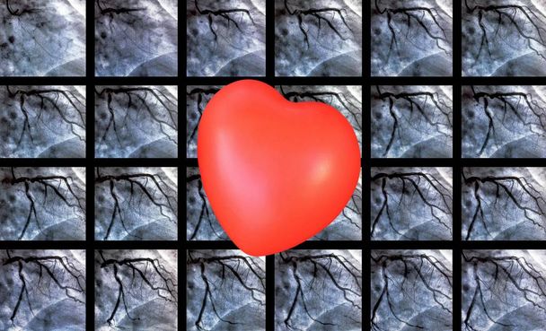 Καθετηριασμό και μικρή κόκκινη καρδιά. Καρδιακή κοιλιογραφία είναι μια ιατρική εξέταση απεικόνισης που χρησιμοποιείται για τον προσδιορισμό ενός ασθενούς καρδιακή λειτουργία στη δεξιά ή αριστερή κοιλία - Φωτογραφία, εικόνα