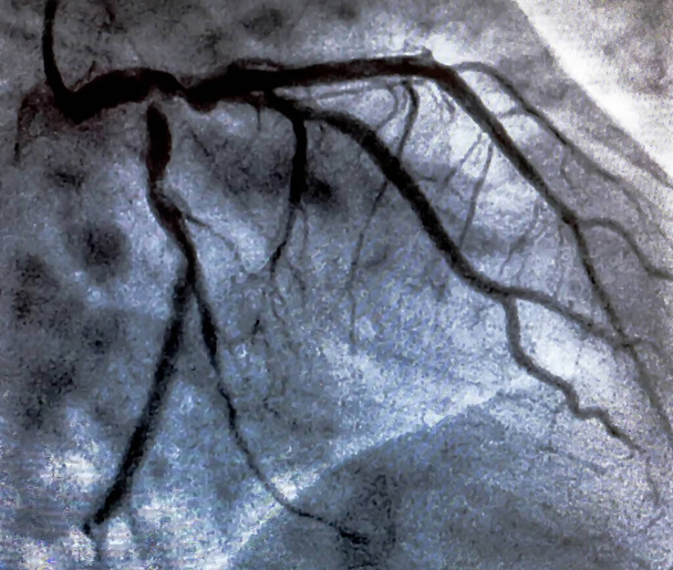 Cathétérisme. La ventriculographie cardiaque est un test d'imagerie médicale utilisé pour déterminer la fonction cardiaque d'un patient dans le ventricule droit ou gauche
 - Photo, image