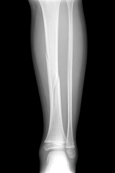 Рентгеновские снимки сломанной ноги, представляющие собой пластину - фиксация винта голени и малоберцовой кости
 - Фото, изображение