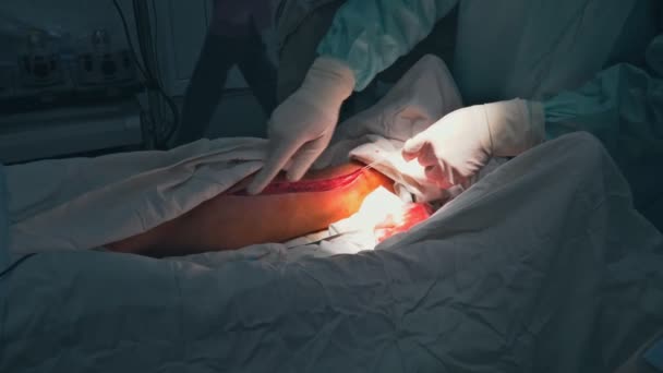 Chirurgia per l'innesto di bypass coronarico in sala operatoria
 - Filmati, video