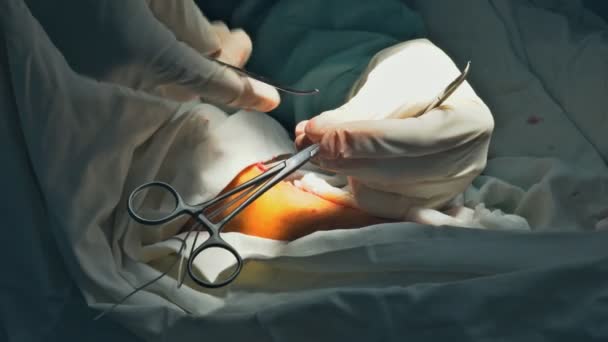 Wunde am Bein mit chirurgischen Werkzeugen während der Operation Krampfadern, Gefäßchirurgie - Filmmaterial, Video