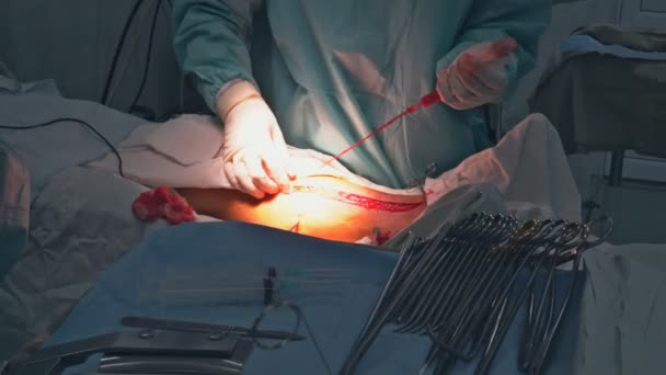 Een chirurg pick uit een ader been naar hart Bypassoperatie - Video